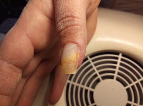 Совет?  Девочки, это мой ноготок, в сентябре убиралась дома и очень сильно ударилась ногтем, появилась пустота. 01