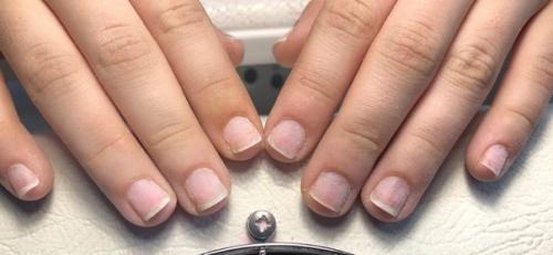 Налипшая кутикула. Девочка обкусывала ноготки - по этой причине кутикула разрослась и налипла на ногти. 02