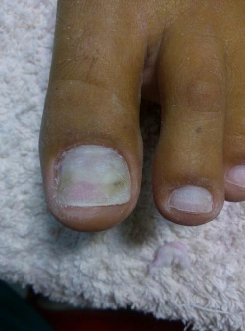 Девочка вот с таким ногтем пришла. 01