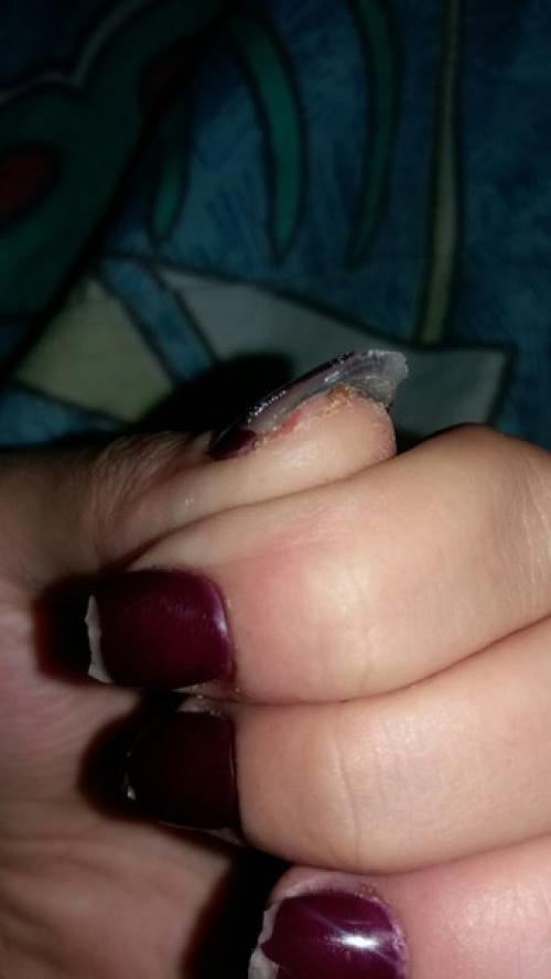 Девочки, ночью проснулась из за того что жудко болели мочки пальцев. 03