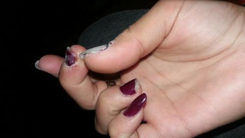 Девочки, ночью проснулась из за того что жудко болели мочки пальцев. 01