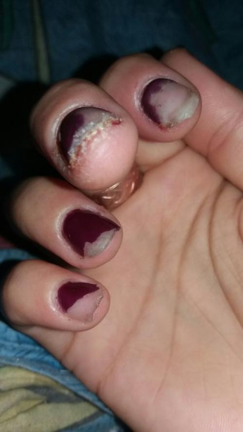 Девочки, ночью проснулась из за того что жудко болели мочки пальцев. 02