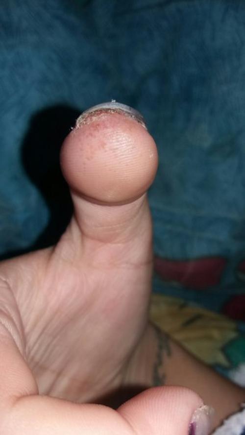 Девочки, ночью проснулась из за того что жудко болели мочки пальцев. 04