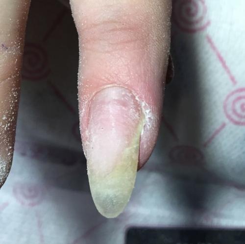 Анонимно.  Девочки!  Подскажите пожалуйста, из за чего может так произойти с ноготком? 01