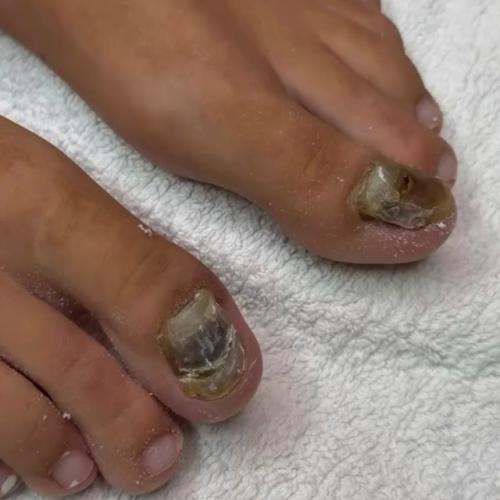 Добрый день!  Прошу совета, если тут есть подологи мастера педикюра. 01