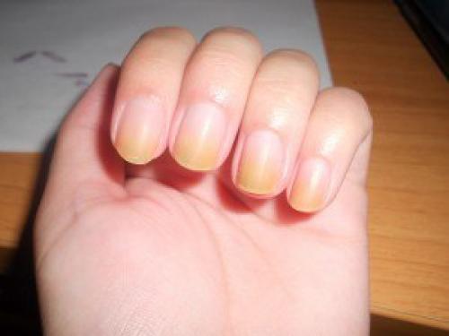 Мы определяем болезнь по ногтям. 05