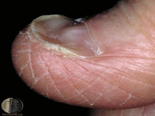 Мы определяем болезнь по ногтям. 01