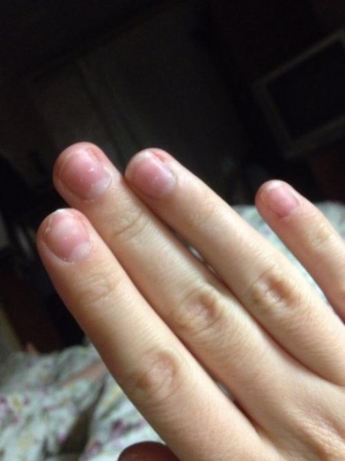 Анон.  Девочки помогите советом, после снятия геля, появились пустоты под ногтем - онихолизис, если неправильно объяснила. 01