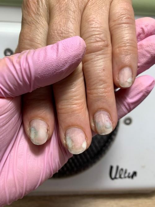 Ожог ногтевой пластины. 03