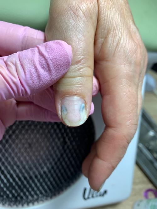 Ожог ногтевой пластины. 02