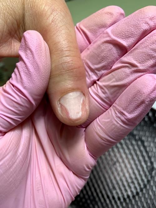 Ожог ногтевой пластины. 01