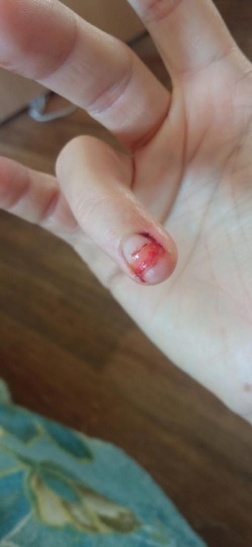 Третьего августа, я сорвала ноготь почти под корень. 01