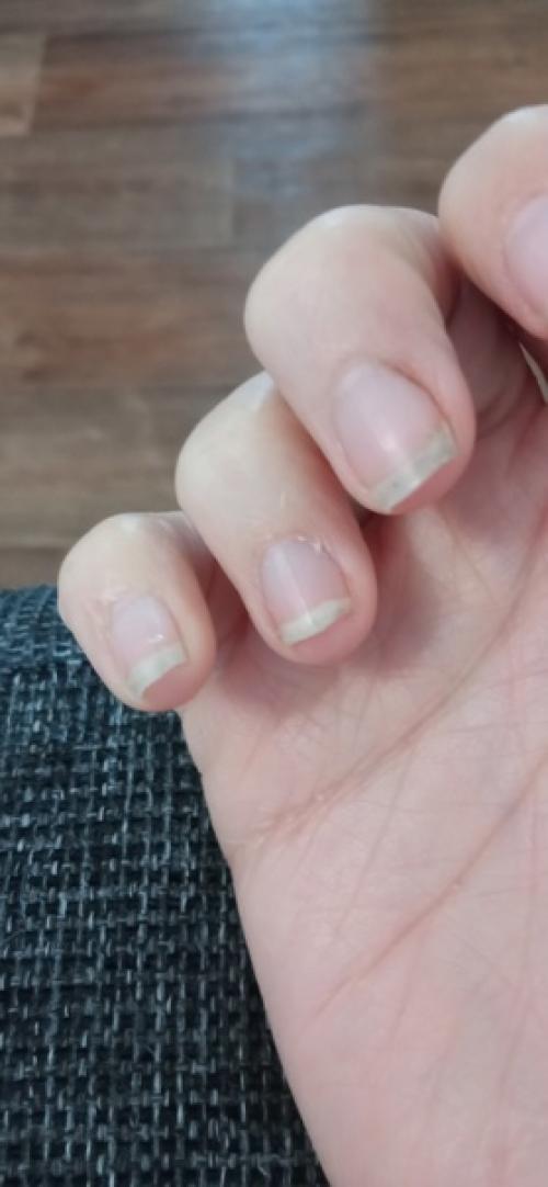 Третьего августа, я сорвала ноготь почти под корень. 02